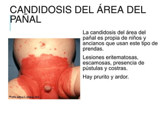 CANDIDOSIS DEL ÁREA DEL
PAÑAL
La candidosis del área del
pañal es propia de niños y
ancianos que usan este tipo de
prendas.
Lesiones eritematosas,
escamosas, presencia de
pústulas y costras.
Hay prurito y ardor.
 