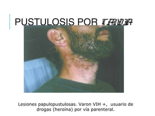 PUSTULOSIS POR CANDIA
Lesiones papulopustulosas. Varon VIH +, usuario de
drogas (heroína) por vía parenteral.
 