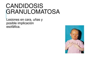 CANDIDOSIS
GRANULOMATOSA
Lesiones en cara, uñas y
posible implicación
esofáfica.
 