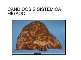 CANDIDOSIS SISTÉMICA
HÍGADO
 
