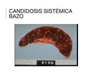 CANDIDOSIS SISTÉMICA
BAZO
 