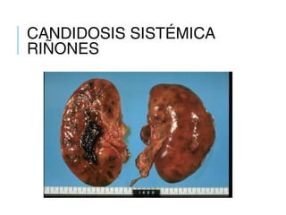 CANDIDOSIS SISTÉMICA
RIÑONES
 