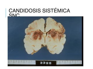CANDIDOSIS SISTÉMICA
SNC
 
