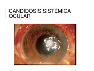 CANDIDOSIS SISTÉMICA
OCULAR
 