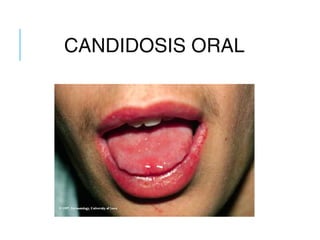 CANDIDOSIS ORAL
 