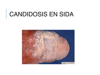 CANDIDOSIS EN SIDA
 