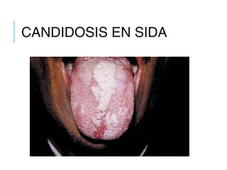 CANDIDOSIS EN SIDA
 