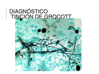 DIAGNÓSTICO
TINCIÓN DE GROCOTT.
 