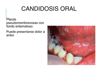 CANDIDOSIS ORAL
Placas
pseudomembranosas con
fondo eritematoso.
Puede presentarse dolor a
ardor.
 