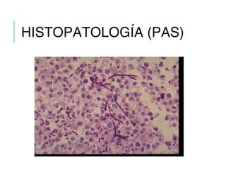 HISTOPATOLOGÍA (PAS)
 