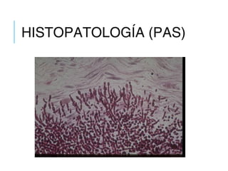 HISTOPATOLOGÍA (PAS)
 