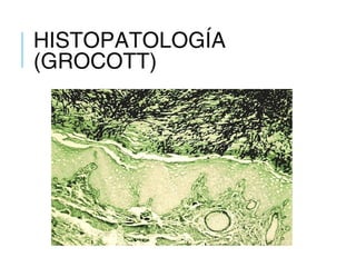 HISTOPATOLOGÍA
(GROCOTT)
 