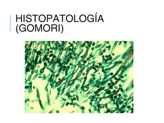 HISTOPATOLOGÍA
(GOMORI)
 