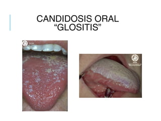 CANDIDOSIS ORAL
“GLOSITIS”
 