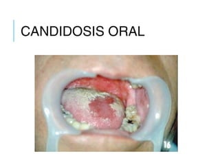 CANDIDOSIS ORAL
 