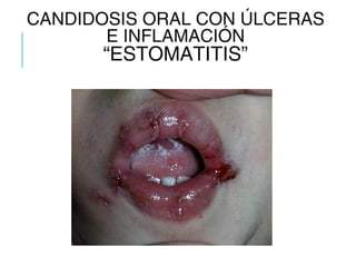 CANDIDOSIS ORAL CON ÚLCERAS
E INFLAMACIÓN
“ESTOMATITIS”
 