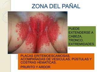 ZONA DEL PAÑAL
PLACAS ERITEMOESCAMOSAS,
ACOMPAÑADAS DE VESICULAS, PÚSTULAS Y
COSTRAS HEMATICAS.
PRURITO Y ARDOR
PUEDE
EXTENDERSE A
CABEZA,
TRONCO,
EXTREMIDADES
.
 