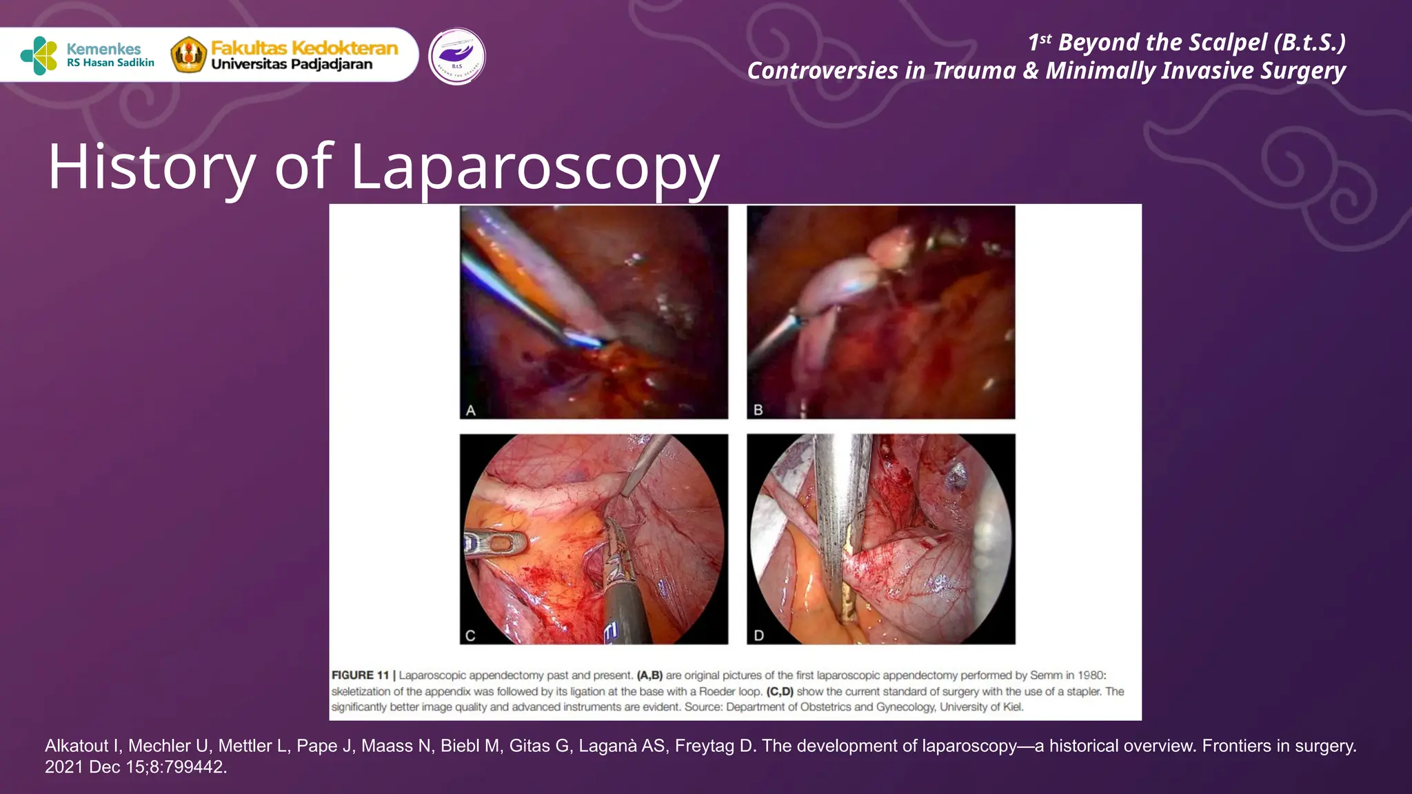 History of Laparoscopy
1st
Beyond the Scalpel (B.t.S.)
Controversies in Trauma & Minimally Invasive Surgery
Alkatout I, Mechler U, Mettler L, Pape J, Maass N, Biebl M, Gitas G, Laganà AS, Freytag D. The development of laparoscopy—a historical overview. Frontiers in surgery.
2021 Dec 15;8:799442.
 