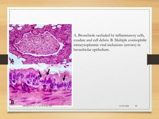 A. Bronchiole occluded by inflammatory cells,
exudate and cell debris. B. Multiple eosinophilic
intracytoplasmic viral inclusions (arrows) in
bronchiolar epithelium.
12-09-2020ABHIJITH SP CVAS POOKODE 20
 