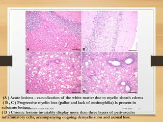 (A ) Acute lesions - vacuolization of the white matter due to myelin sheath edema
( B , C ) Progressive myelin loss (pallor and lack of eosinophilia) is present in
subacute lesions.
( D ) Chronic lesions invariably display more than three layers of perivascular
inflammatory cells, accompanying ongoing demyelination and axonal loss.
24-09-2020ABHIJITH SP CVAS POOKODE 21
 