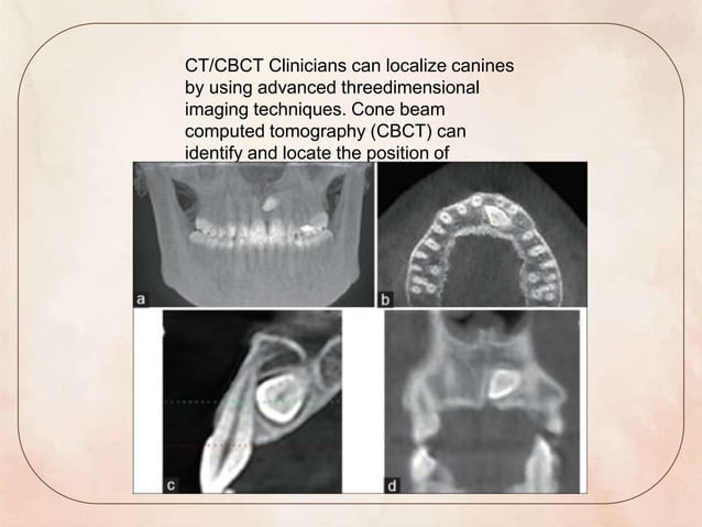 CANINE IMPACTION 1.pptx