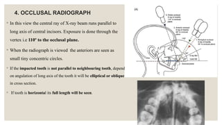 Comprehensive Overview of Canine Impaction: Etiology, Classification ...
