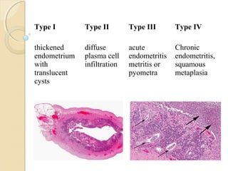 Type I Type II Type III Type IV
thickened
endometrium
with
translucent
cysts
diffuse
plasma cell
infiltration
acute
endometritis
metritis or
pyometra
Chronic
endometritis,
squamous
metaplasia
 