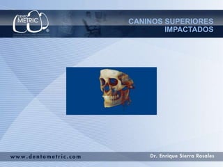 CANINOS SUPERIORES 
IMPACTADOS 
 