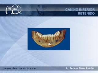 CANINO INFERIOR
      RETENIDO
 