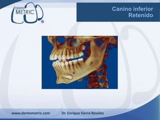 www.dentometric.com Dr. Enrique Sierra Rosales
Canino inferior
Retenido
 