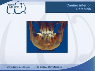 www.dentometric.com Dr. Enrique Sierra Rosales
Canino inferior
Retenido
 