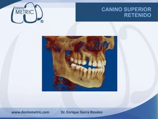 CANINO SUPERIOR
RETENIDO
www.dentometric.com Dr. Enrique Sierra Rosales
 