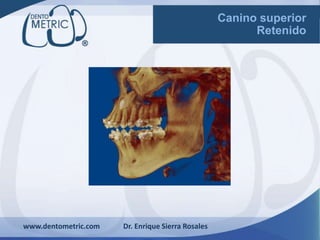www.dentometric.com Dr. Enrique Sierra Rosales
Canino superior
Retenido
 