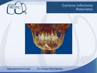 www.dentometric.com Dr. Enrique Sierra Rosales
Caninos inferiores
Retenidos
 