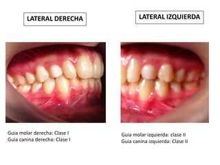 LATERAL DERECHA

Guia molar derecha: Clase I
Guia canina derecha: Clase I

LATERAL IZQUIERDA

Guia molar izquierda: clase II
Guia canina izquierda: Clase II

 