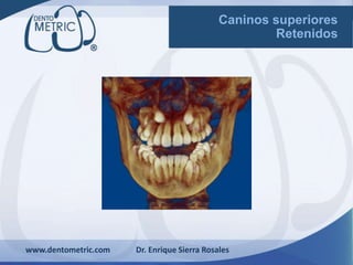 www.dentometric.com Dr. Enrique Sierra Rosales
Caninos superiores
Retenidos
 