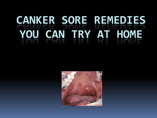 CANKER SORE REMEDIES
YOU CAN TRY AT HOME
 