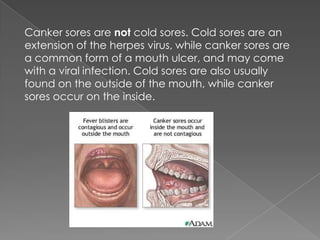 Canker sores | PPTX