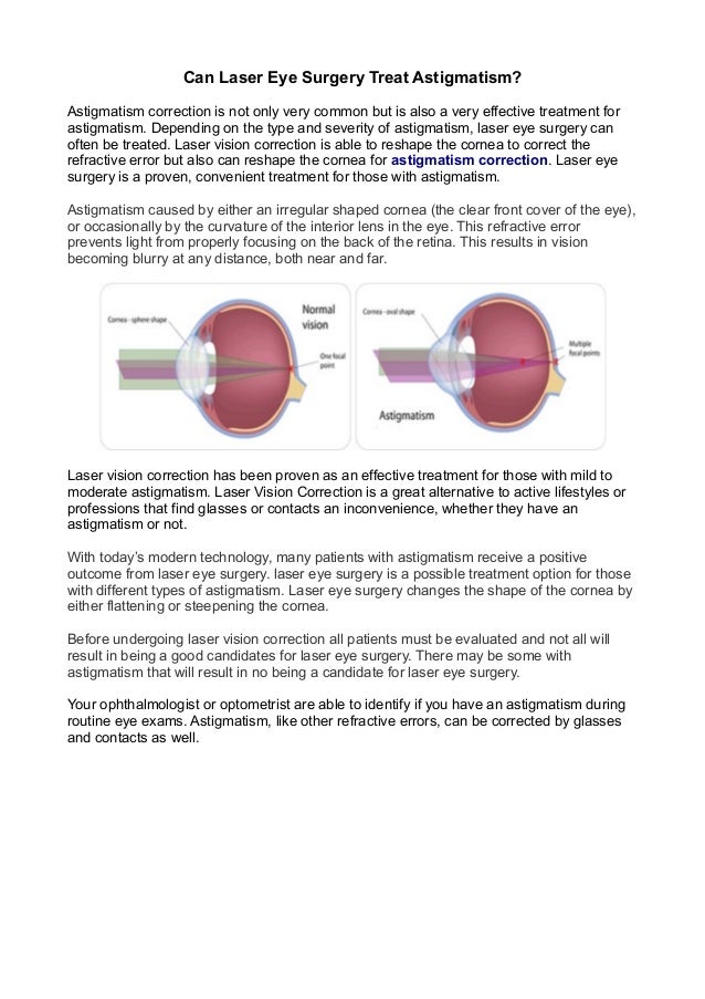 Can laser eye surgery treat astigmatism