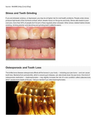 Source: WebMD (http://urly.fi/lay)
Stress and Teeth Grinding
If you are stressed, anxious, or depressed, you may be at higher risk for oral health problems. People under stress
produce high levels of the hormone cortisol, which wreaks havoc on the gums and body. Stress also leads to poor
oral care; more than 50% of people don't brush or floss regularly when stressed. Other stress-related habits include
smoking, drinking alcohol, and clenching and grinding teeth (called bruxism).
Osteoporosis and Tooth Loss
The brittle bone disease osteoporosis affects all the bones in your body -- including your jaw bone -- and can cause
tooth loss. Bacteria from periodontitis, which is severe gum disease, can also break down the jaw bone. One kind of
osteoporosis medication -- bisphosphonates -- may slightly increase the risk of a rare condition called osteonecrosis,
which causes bone death of the jaw. Tell your dentist if you take bisphosphonates.
 