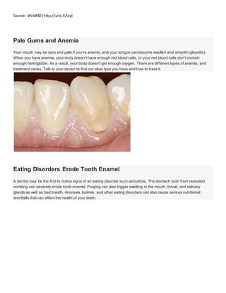 Source: WebMD (http://urly.fi/lay)
Pale Gums and Anemia
Your mouth may be sore and pale if you're anemic, and your tongue can become swollen and smooth (glossitis).
When you have anemia, your body doesn't have enough red blood cells, or your red blood cells don't contain
enough hemoglobin. As a result, your body doesn't get enough oxygen. There are different types of anemia, and
treatment varies. Talk to your doctor to find out what type you have and how to treat it.
Eating Disorders Erode Tooth Enamel
A dentist may be the first to notice signs of an eating disorder such as bulimia. The stomach acid from repeated
vomiting can severely erode tooth enamel. Purging can also trigger swelling in the mouth, throat, and salivary
glands as well as bad breath. Anorexia, bulimia, and other eating disorders can also cause serious nutritional
shortfalls that can affect the health of your teeth.
 