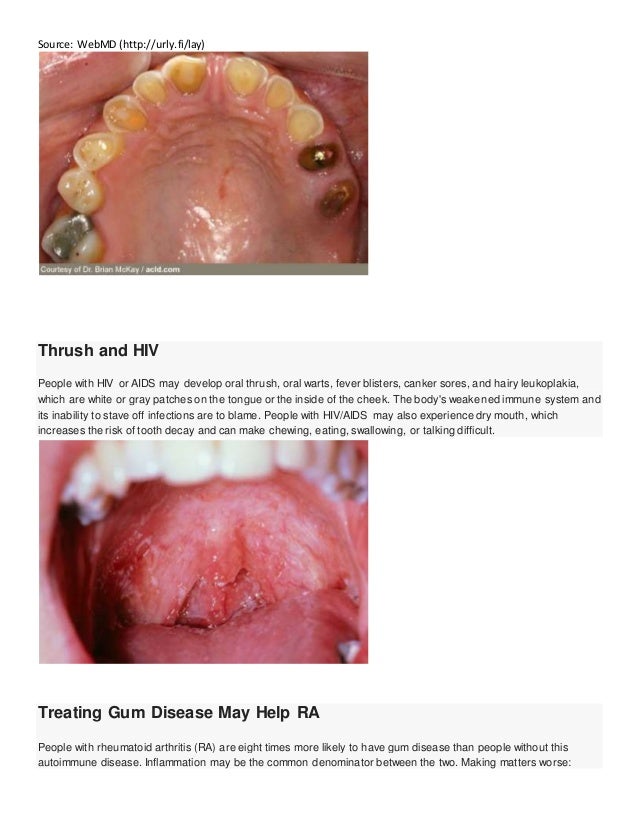 Can mouth bacteria affect the heart