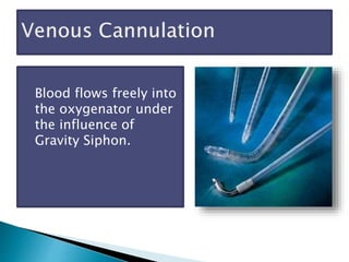 Blood flows freely into
the oxygenator under
the influence of
Gravity Siphon.
 