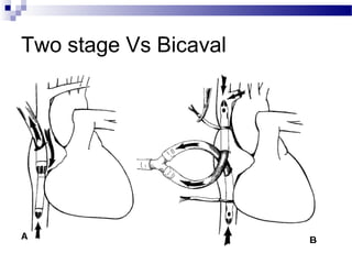 Two stage Vs Bicaval
 