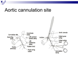Aortic cannulation site
 