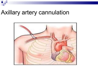 Axillary artery cannulation
 