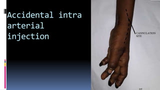 Accidental intra
arterial
injection
 