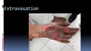 Extravasation
 