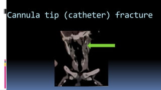 Cannula tip (catheter) fracture
 
