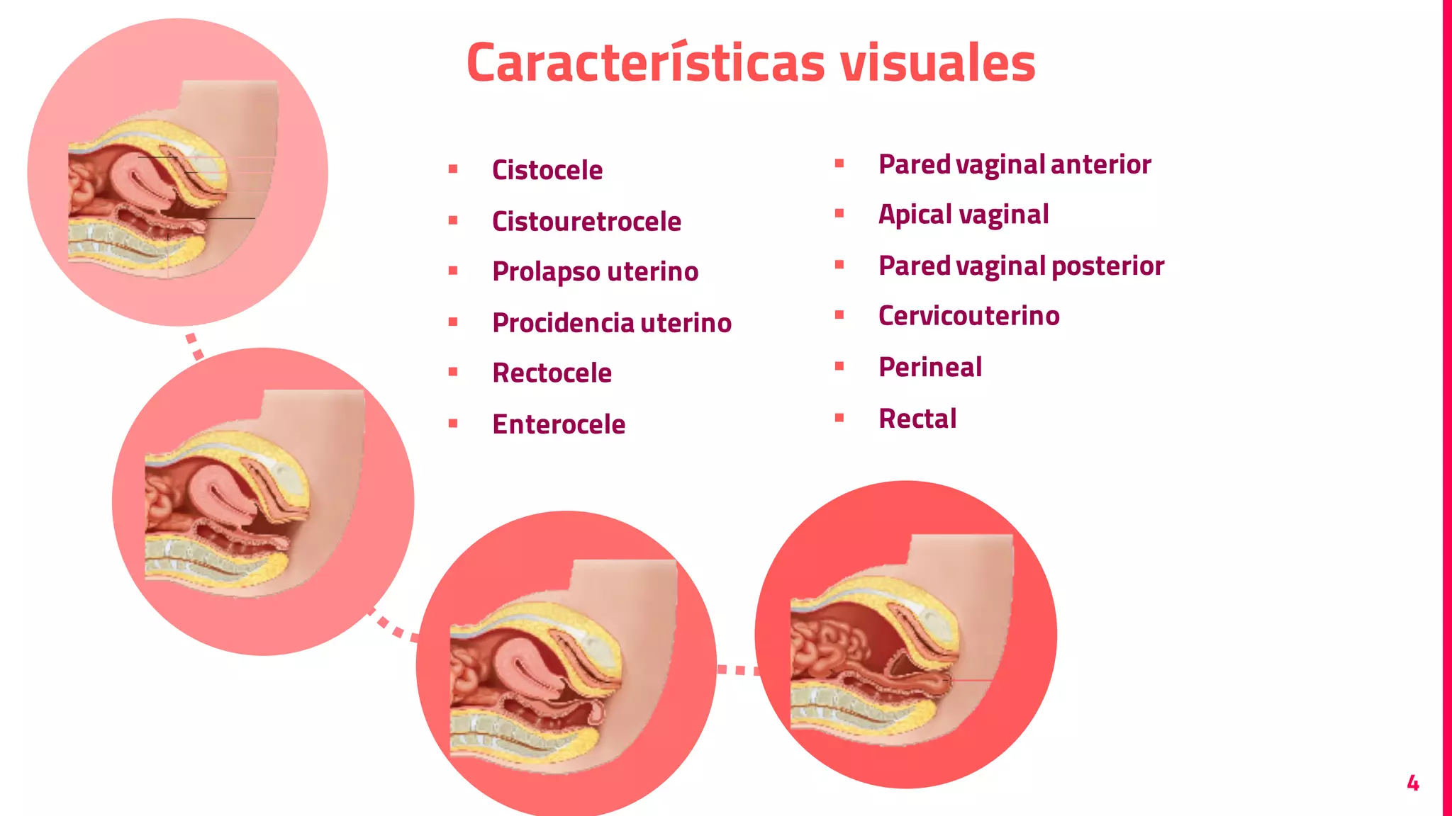 Prolapso de órganos pélvicos | PDF | Reproductive Health | Diseases and ...